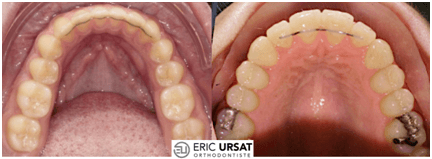 contention orthodontie Strasbourg Eric URSAT 