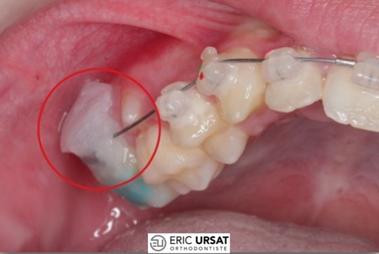 urgence orthodontie 
