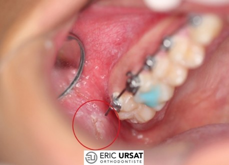 fil qui pique appareil orthodontie urgence