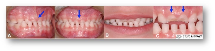 Malocclusion dentaire