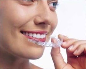 Invisalign : aligner vos dents par gouttière invisible