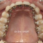 Orthodontie Invisible