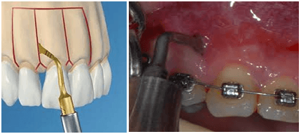 L'orthodontie rapide