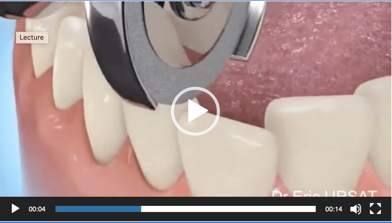 Stripping dentaire (ou remodelage dentaire), Dr Eric Ursat
