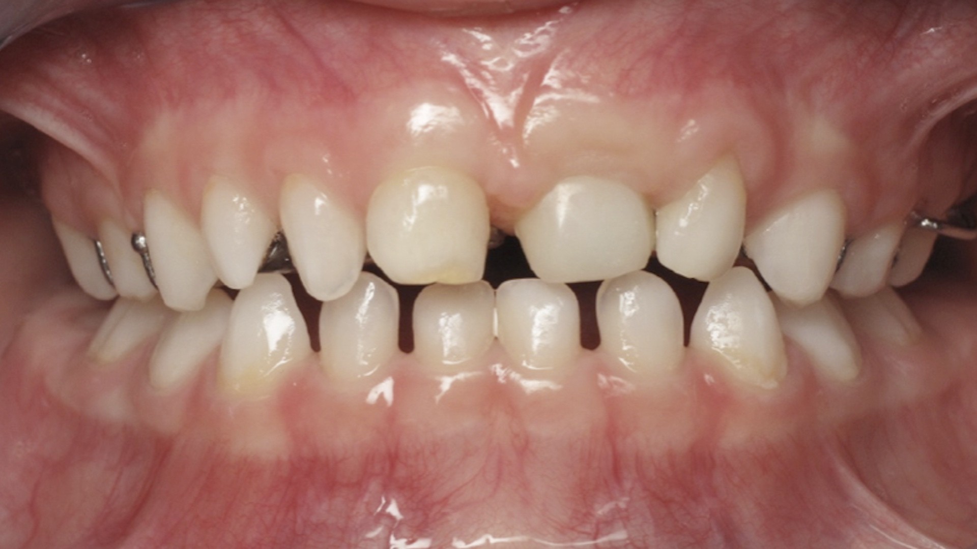 Le bilan première étape du traitement orthodontique.