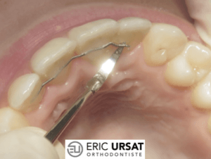 fil contention orthodontie décollée