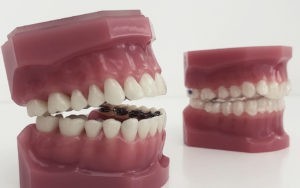 Orthodontie chez l'adulte
