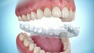Orthodontie invisible Lyon, Gouttière transparente - Orthodontiste