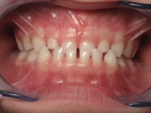 traitement précoce fonctionnel orthodontie