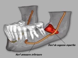 Dent de sagesse incluse orthodontiste strasbourg Dr Eric URSAT