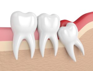 Dents de sagesse et Orthodontie